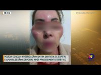 policia-conclui-investigacao-contra-dentista-e-aponta-lesao-corporal-apos-procedimento-estetico